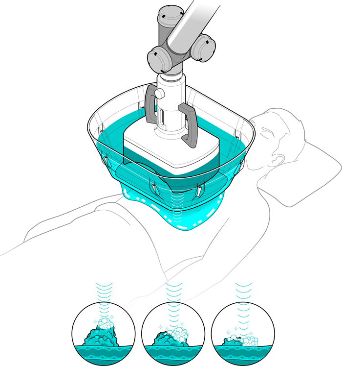 Phẫu thuật bằng sóng âm: Khi bong bóng trở thành vũ khí chống ung thư